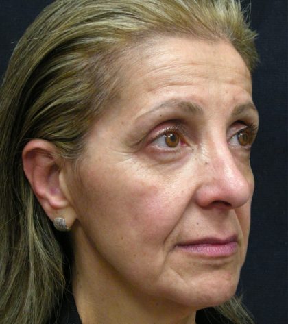 Levinelift Before & After Patient #1988