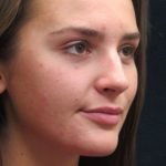Rhinoplasty Before & After Patient #2926