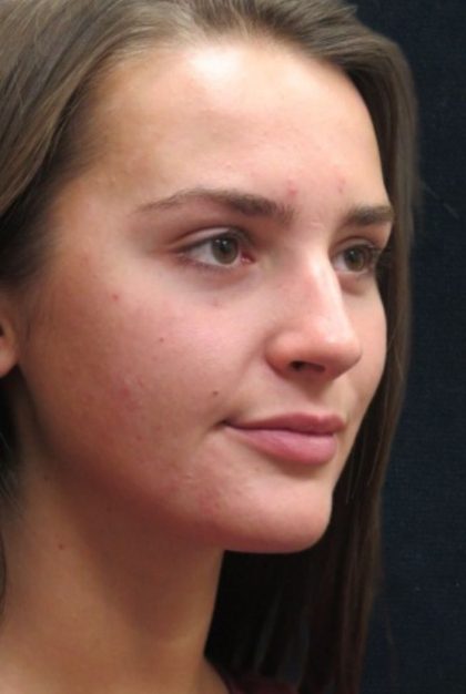 Rhinoplasty Before & After Patient #2926