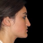 Rhinoplasty Before & After Patient #2919