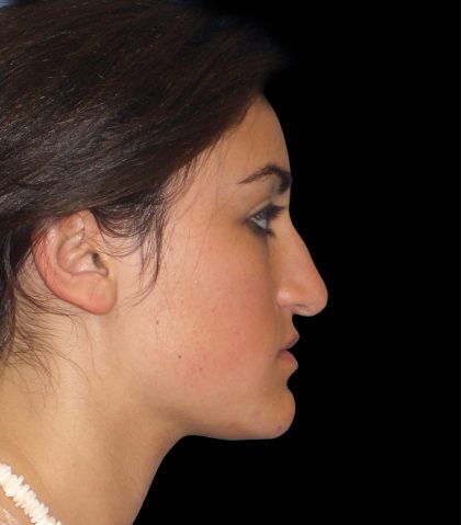 Rhinoplasty Before & After Patient #2919