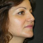 Rhinoplasty Before & After Patient #2805