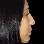 Rhinoplasty Before & After Patient #2912