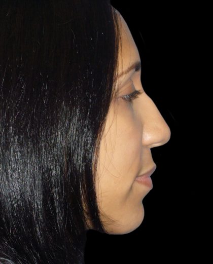 Rhinoplasty Before & After Patient #2912