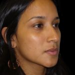 Rhinoplasty Before & After Patient #2905