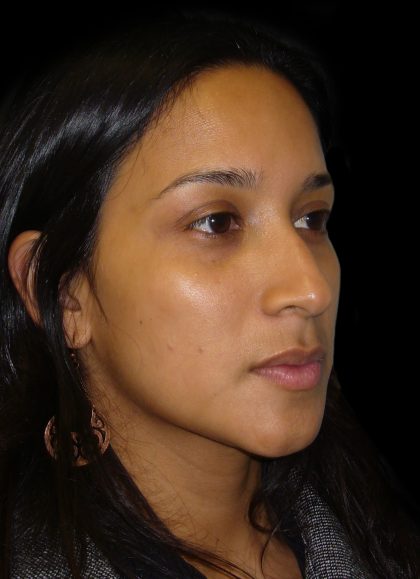 Rhinoplasty Before & After Patient #2905
