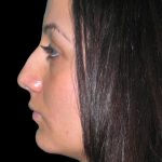 Rhinoplasty Before & After Patient #2819