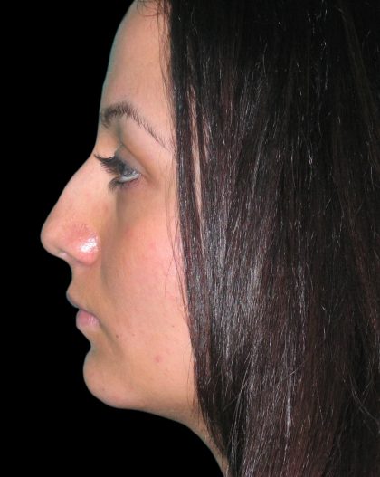 Rhinoplasty Before & After Patient #2819
