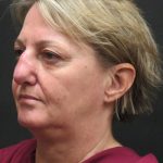 Rhinoplasty Before & After Patient #2826