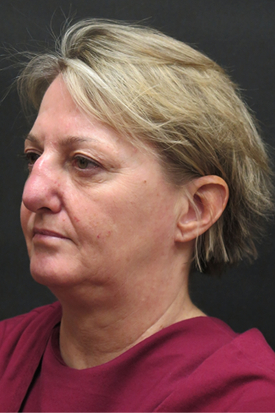 Rhinoplasty Before & After Patient #2826