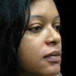 Rhinoplasty Before & After Patient #2812