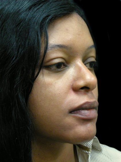 Rhinoplasty Before & After Patient #2812