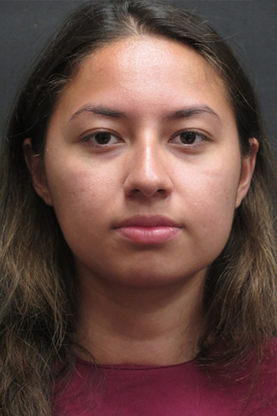 Rhinoplasty Before & After Patient #2798