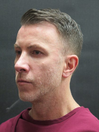 Rhinoplasty Before & After Patient #2870