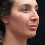 Rhinoplasty Before & After Patient #2851