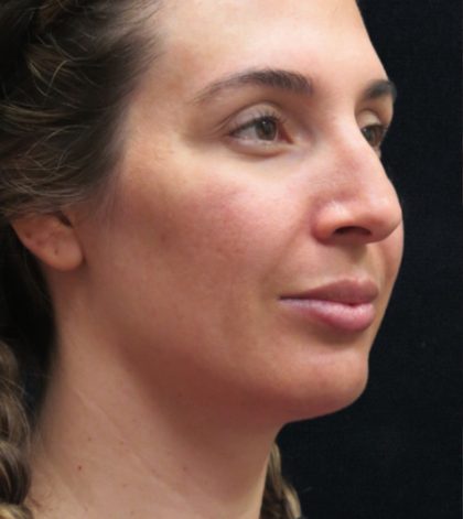 Rhinoplasty Before & After Patient #2851
