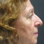 Rhinoplasty Before & After Patient #2891