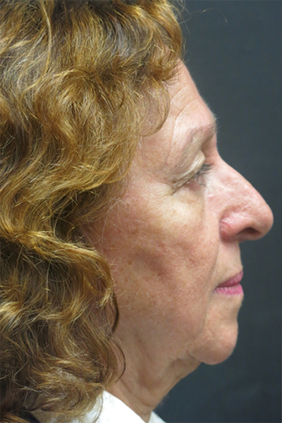 Rhinoplasty Before & After Patient #2891