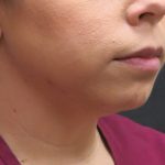 Chin Augmentation Before & After Patient #1561