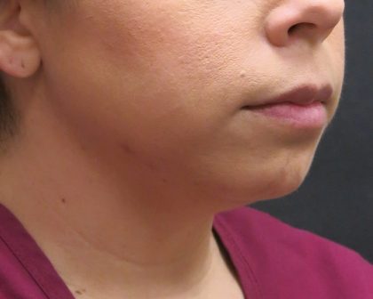 Chin Augmentation Before & After Patient #1561