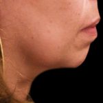 Chin Augmentation Before & After Patient #1566