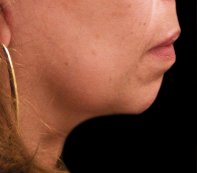 Chin Augmentation Before & After Patient #1566