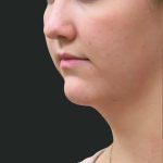 Fat Transfer Before & After Patient #1782