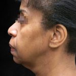 Fat Transfer Before & After Patient #1770