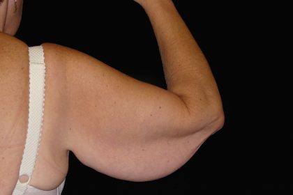 Arm Lift Before & After Patient #922