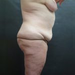 Mommy Makeover Before & After Patient #2542