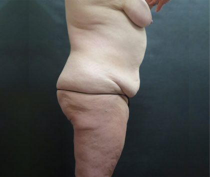 Mommy Makeover Before & After Patient #2542