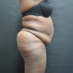 Mommy Makeover Before & After Patient #2503