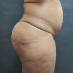 Mommy Makeover Before & After Patient #2618