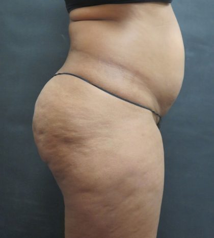 Mommy Makeover Before & After Patient #2618