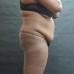 Mommy Makeover Before & After Patient #2529