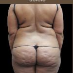 Liposuction Before & After Patient #2175