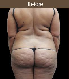 Liposuction Before & After Patient #2175