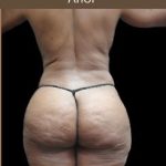 Liposuction Before & After Patient #2175