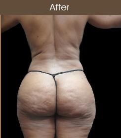 Liposuction Before & After Patient #2175