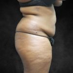 Mommy Makeover Before & After Patient #2587
