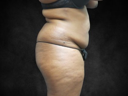 Mommy Makeover Before & After Patient #2587