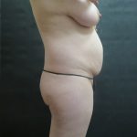 Mommy Makeover Before & After Patient #2563