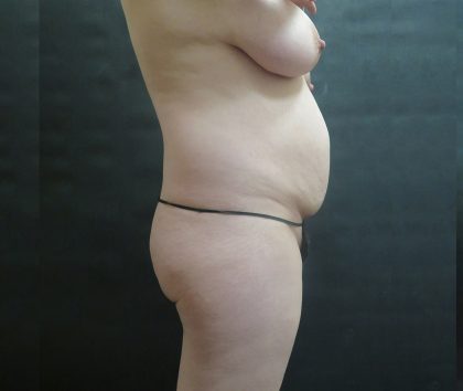 Mommy Makeover Before & After Patient #2563