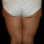 Thigh Lift Before & After Patient #3128