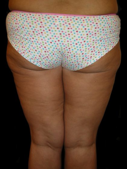 Thigh Lift Before & After Patient #3128