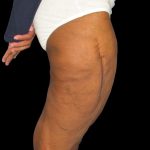Thigh Lift Before & After Patient #3137