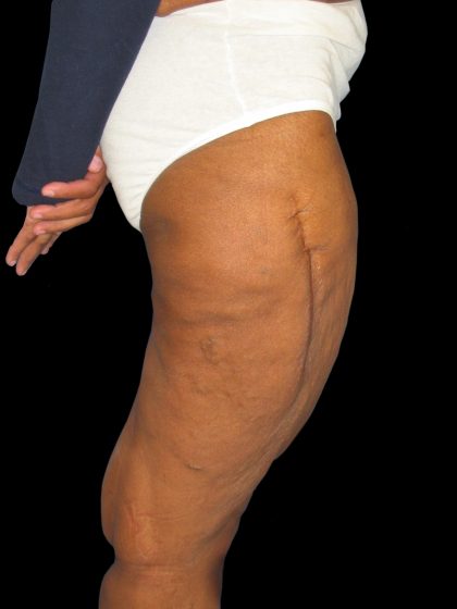 Thigh Lift Before & After Patient #3137