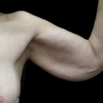 Arm Lift Before & After Patient #904