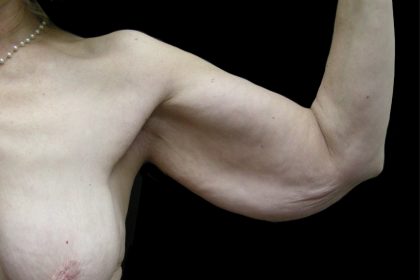 Arm Lift Before & After Patient #904