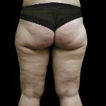 Thigh Lift Before & After Patient #3113